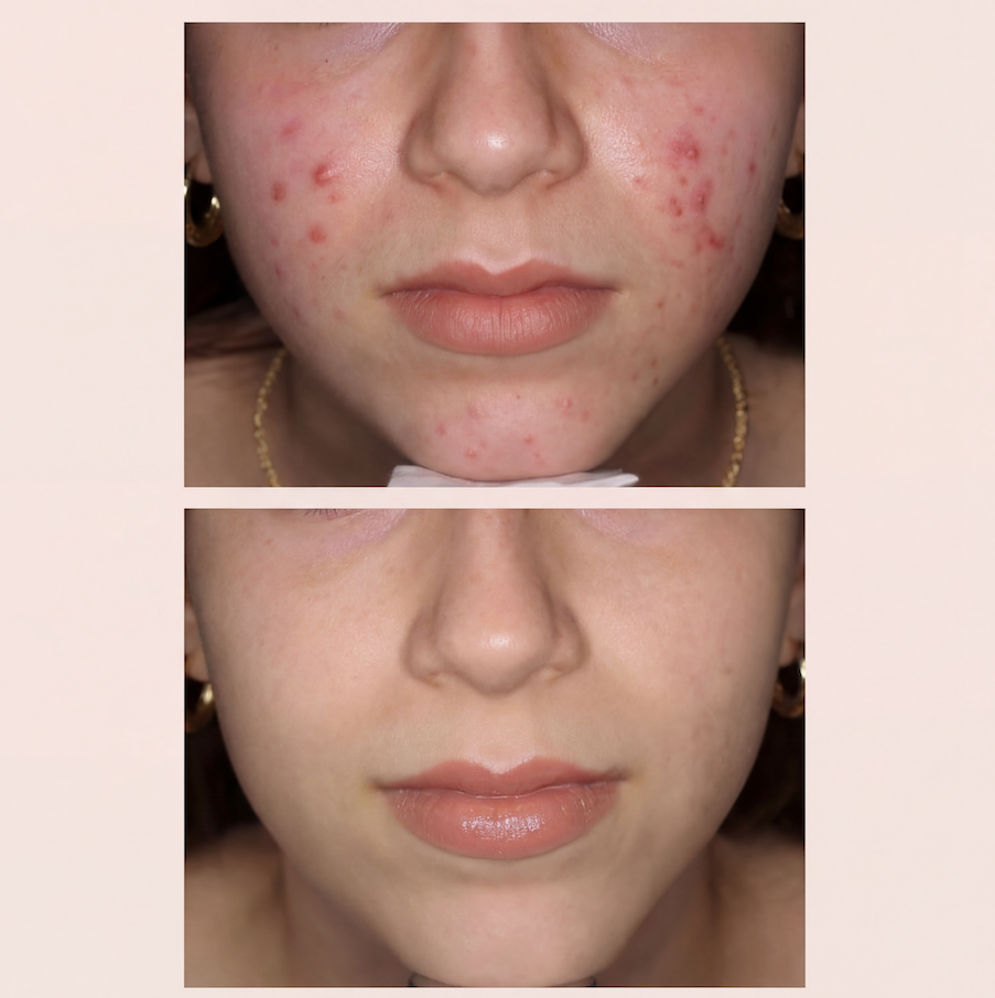 Jabón Dermo Reparador con Tepezcohuite